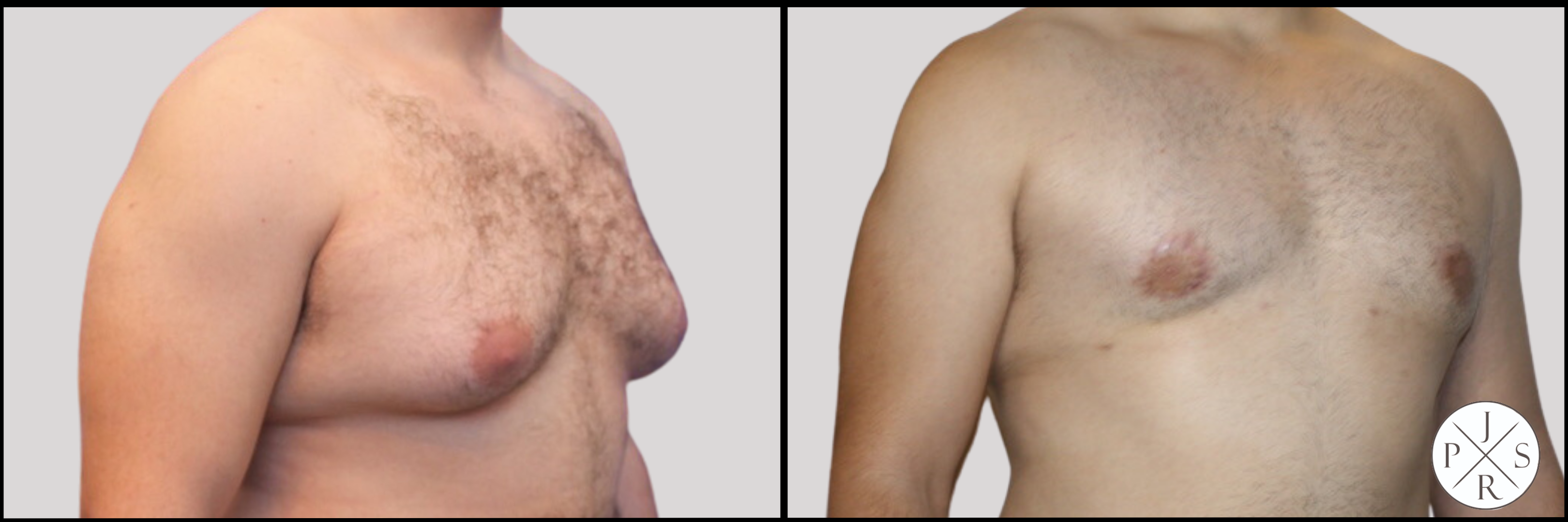 Gynaecomastia Before & After Image